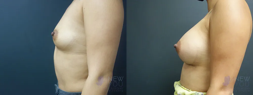 breast-augmentation-61a-ba3