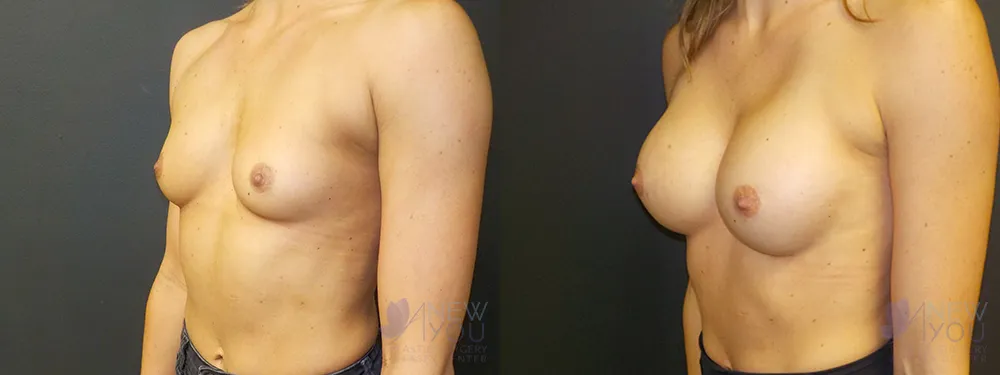 breast-augmentation-63a-ba2