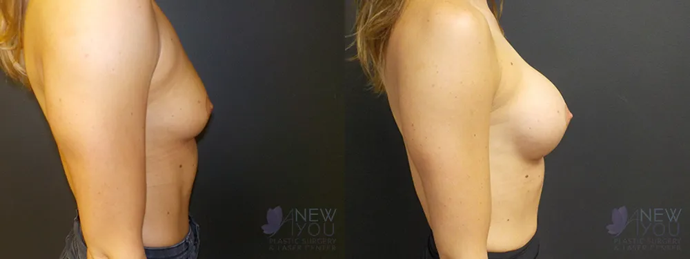 breast-augmentation-63a-ba3