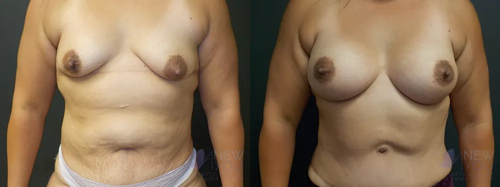 breast-augmentation-64a-ba1