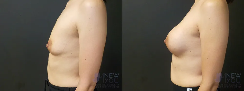 breast-augmentation-65a-ba3