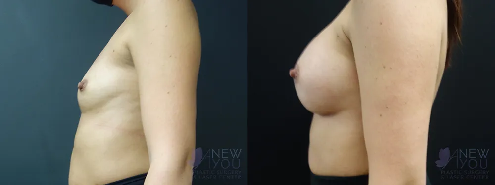 breast-augmentation-66a-ba3