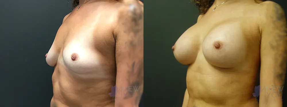 breast-augmentation-67a-ba2