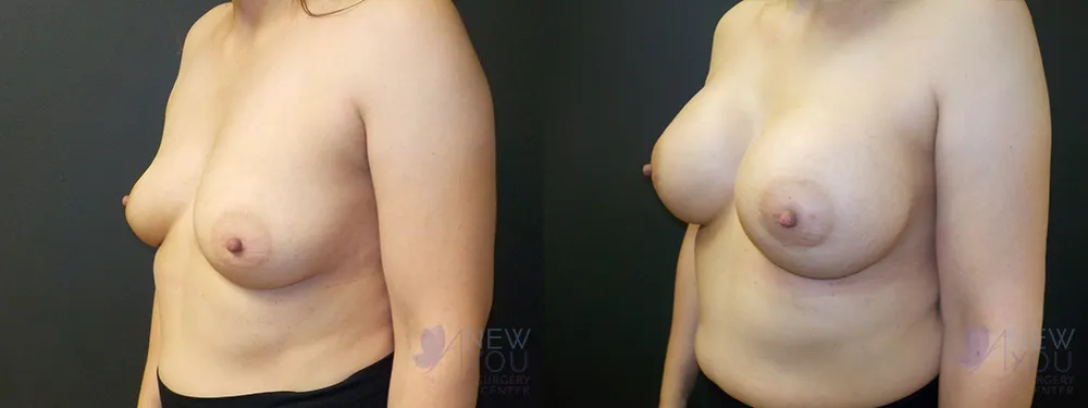 breast-augmentation-69a-ba2