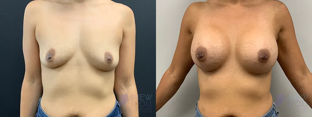 breast-augmentation-70a-ba1