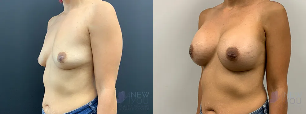 breast-augmentation-70a-ba2