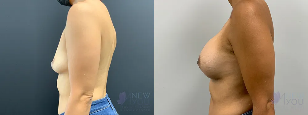 breast-augmentation-70a-ba3