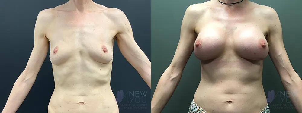 breast-augmentation-72a-ba1
