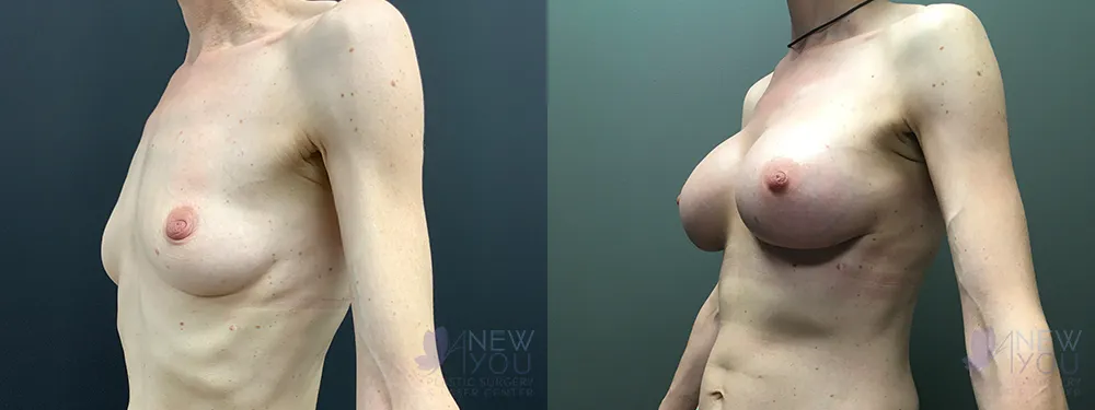 breast-augmentation-72a-ba2