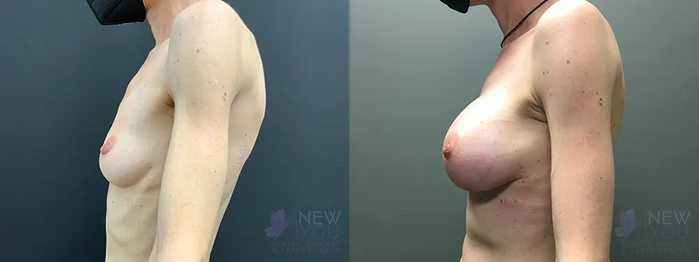 breast-augmentation-72a-ba3