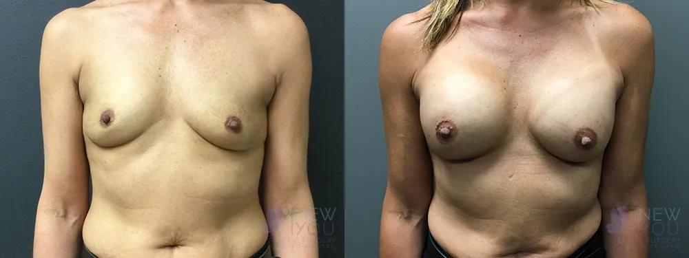 breast-augmentation-73a-ba1