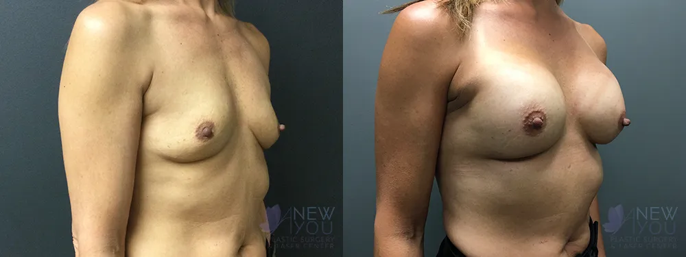 breast-augmentation-73a-ba2
