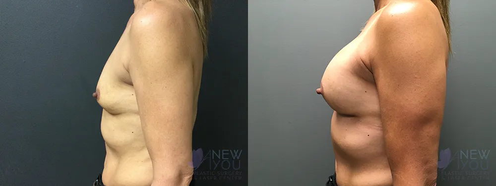 breast-augmentation-73a-ba3