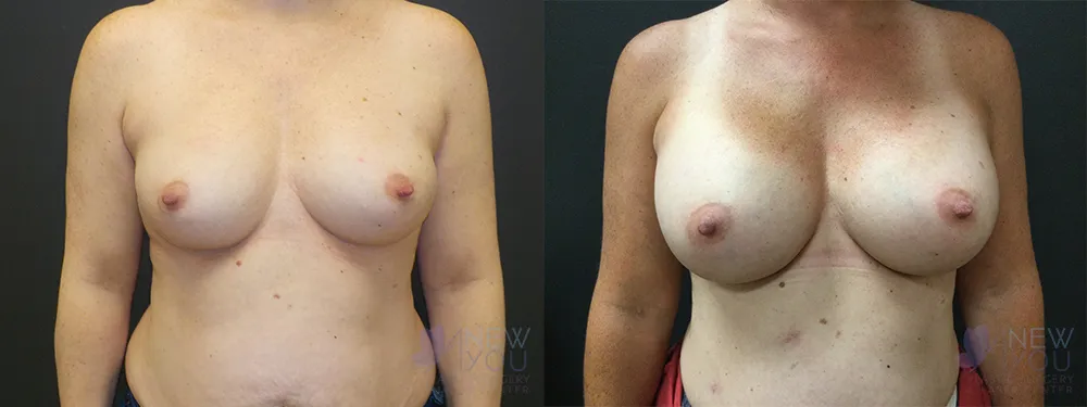 breast-augmentation-74a-ba1