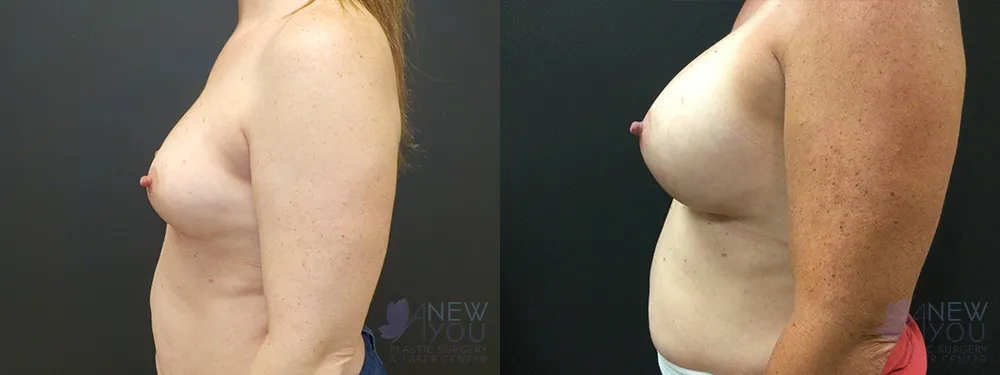 breast-augmentation-74a-ba3