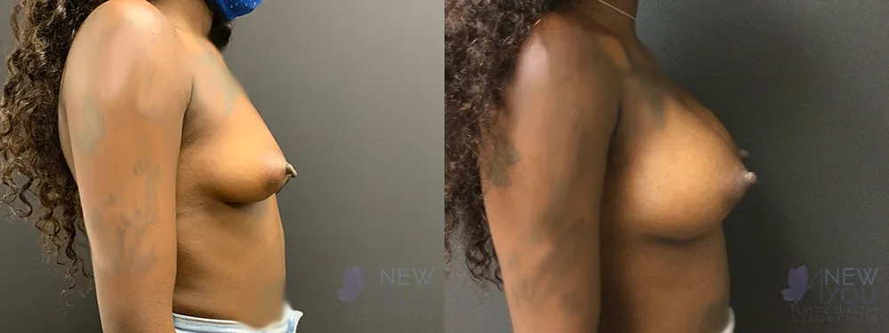 breast-augmentation-76a-ba3