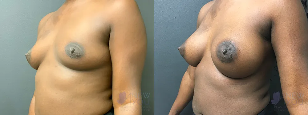 breast-augmentation-77a-ba2