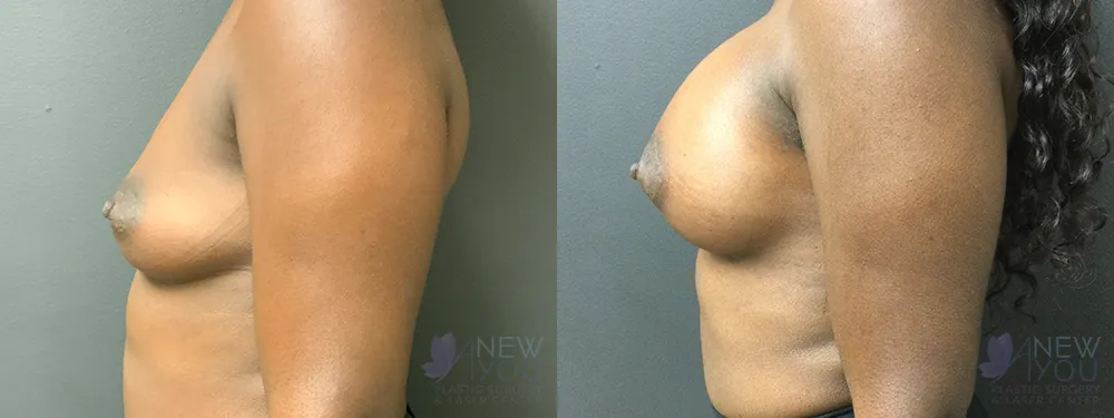 breast-augmentation-77a-ba3