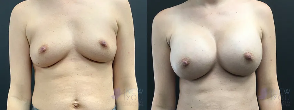breast-augmentation-78a-ba1