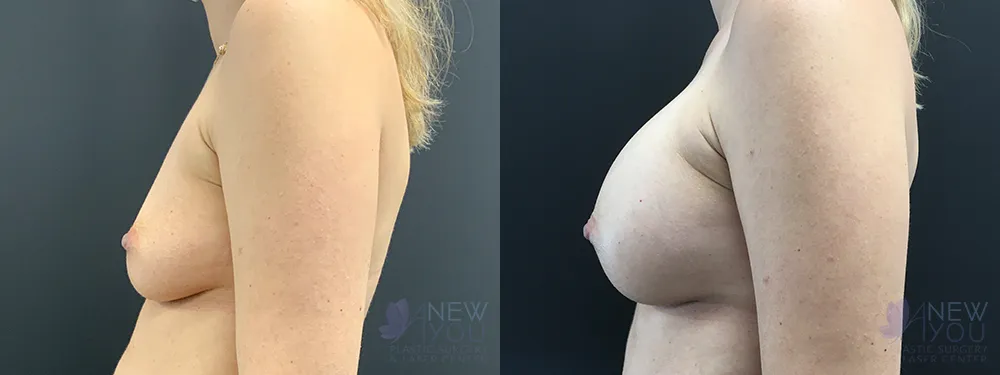 breast-augmentation-78a-ba2