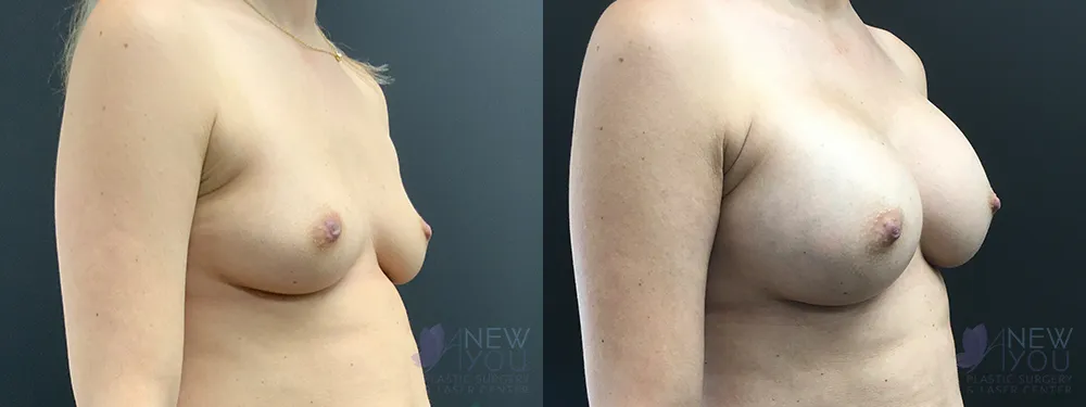 breast-augmentation-78a-ba3