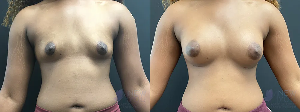 breast-augmentation-79a-ba1