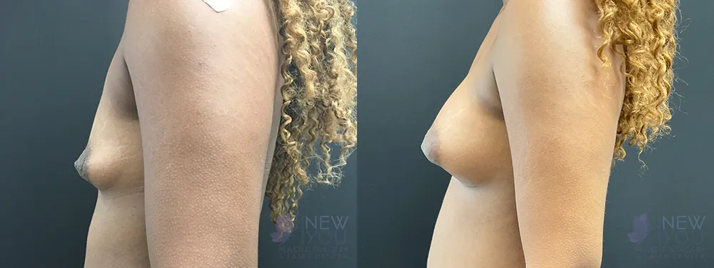 breast-augmentation-79a-ba2