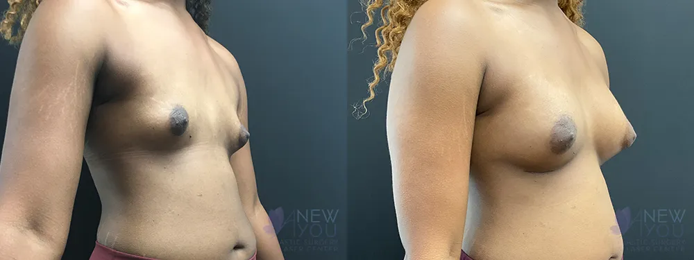 breast-augmentation-79a-ba3