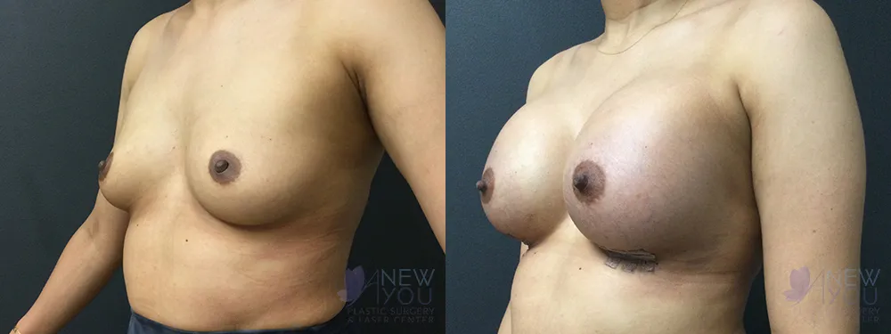 breast-augmentation-80a-ba2