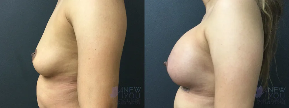 breast-augmentation-80a-ba3