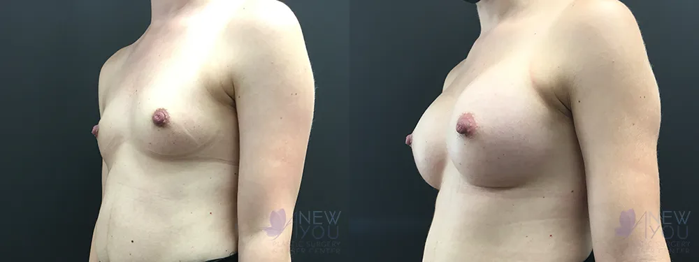 breast-augmentation-81a-ba2