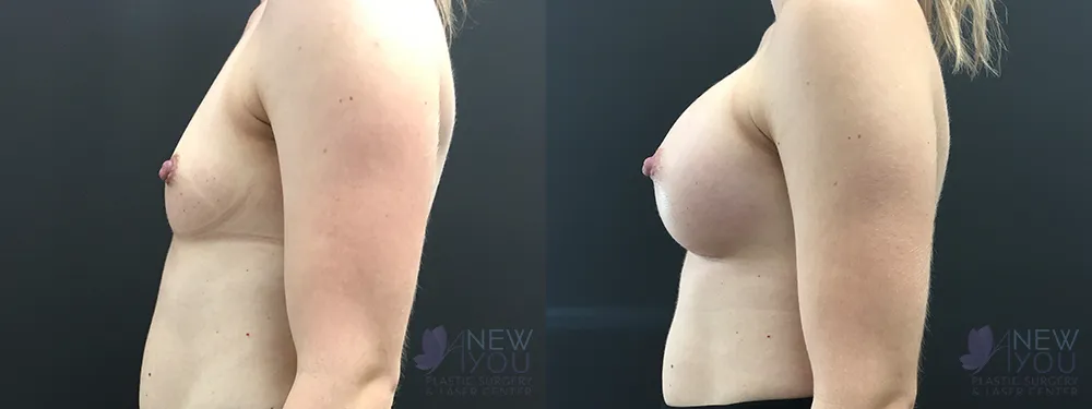breast-augmentation-81a-ba3