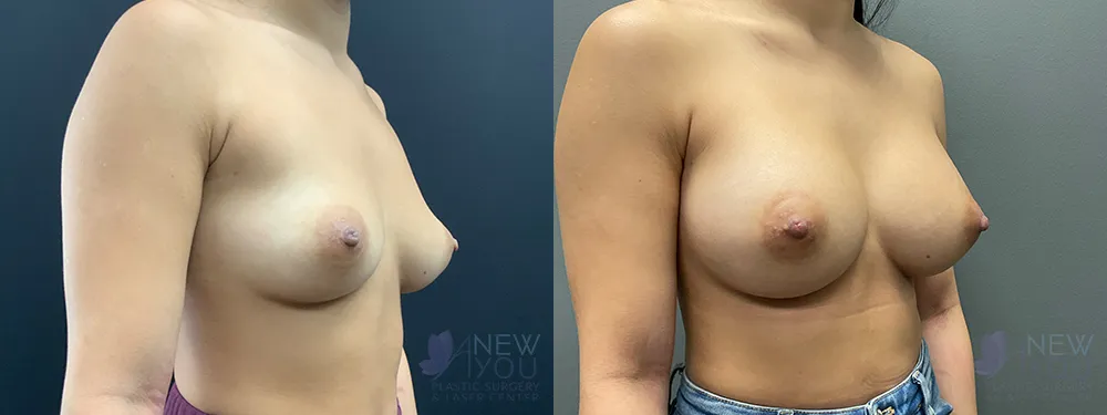 breast-augmentation-82a-ba3