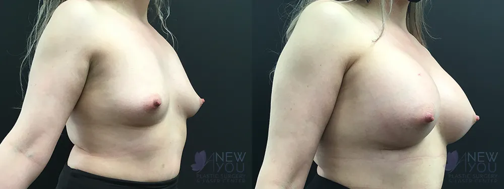 breast-augmentation-83a-ba2