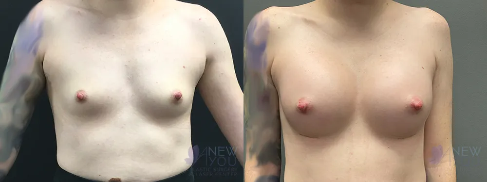 breast-augmentation-84a-bA1