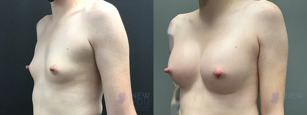 breast-augmentation-84a-bA2