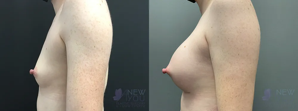 breast-augmentation-84a-bA3