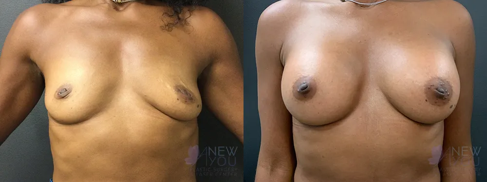 breast-augmentation-85a-bA1