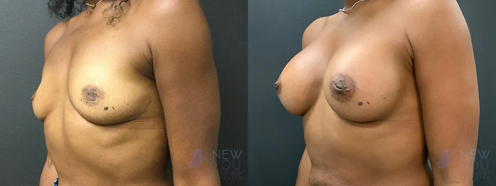 breast-augmentation-85a-bA2