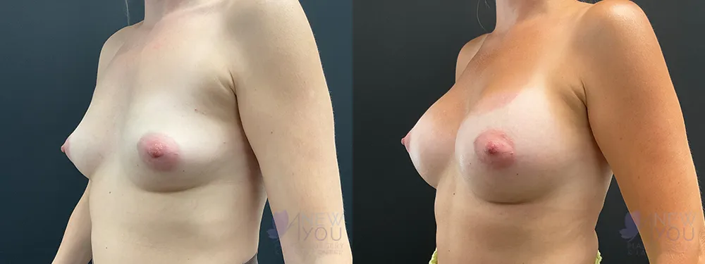 breast-augmentation-86a-ba2