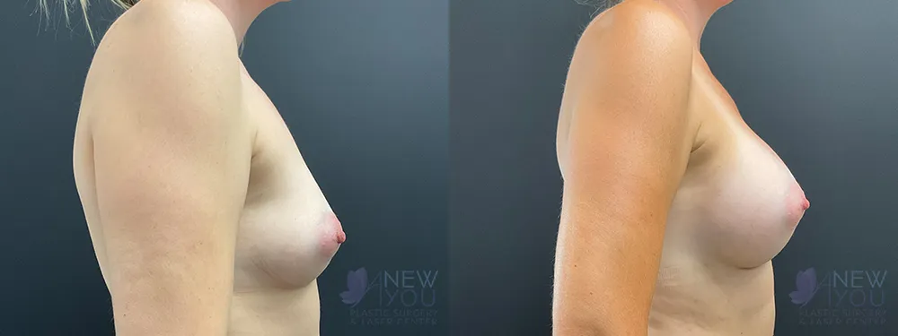 breast-augmentation-86a-ba3