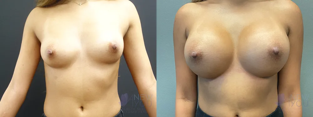 breast-augmentation-87a-ba1