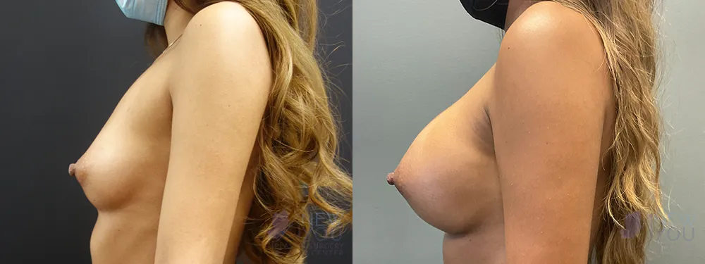 breast-augmentation-87a-ba3
