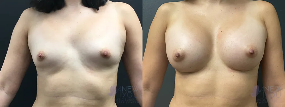 breast-augmentation-88a-ba1