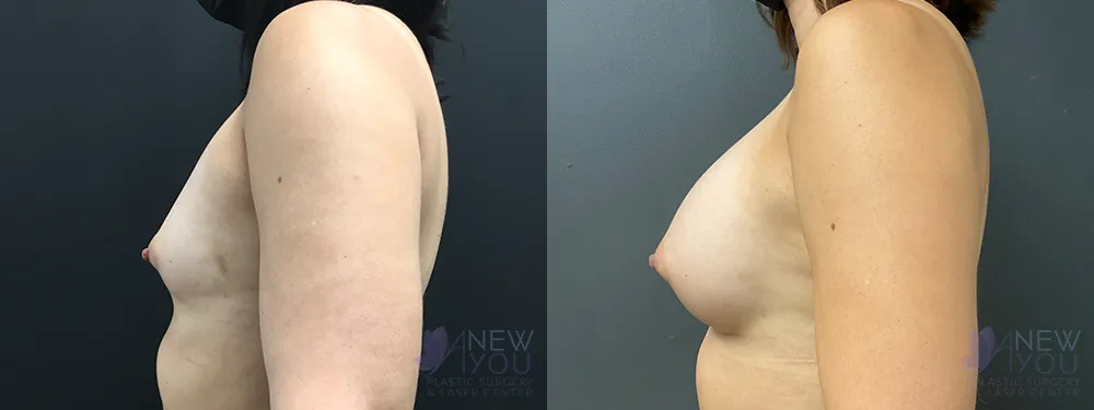 breast-augmentation-88a-ba3