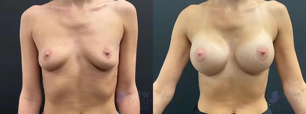 breast-augmentation-89a-ba1