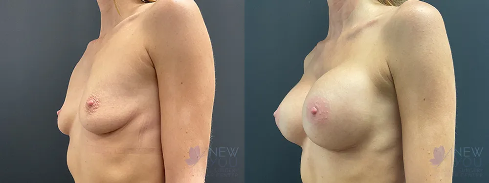 breast-augmentation-89a-ba2