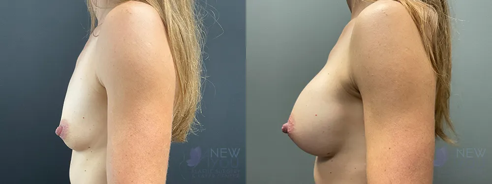 breast-augmentation-91a-ba3
