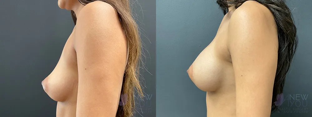 breast-augmentation-92a-ba3