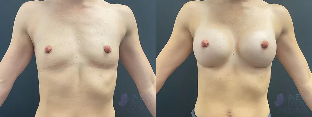 breast-augmentation-93a-ba1